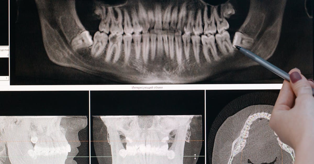 Cover Image for Invisible Teeth Aligners: Your Ultimate Guide to a Confident Smile